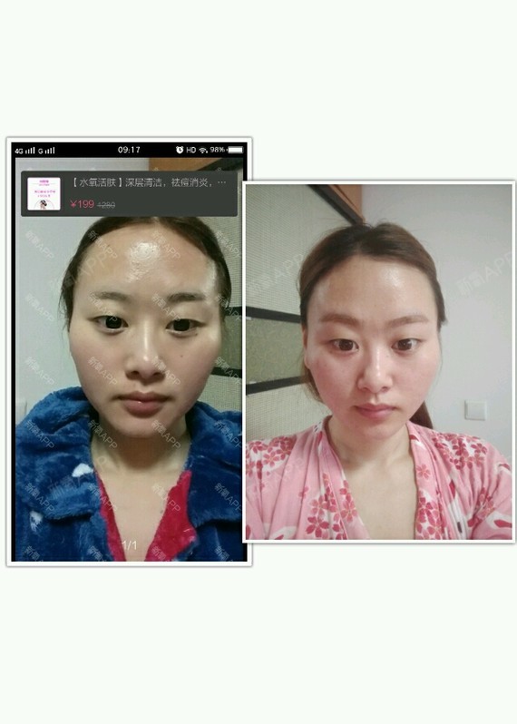 南京光子嫩肤好不好_效果图_凌梓沫o0o光子嫩肤术后第