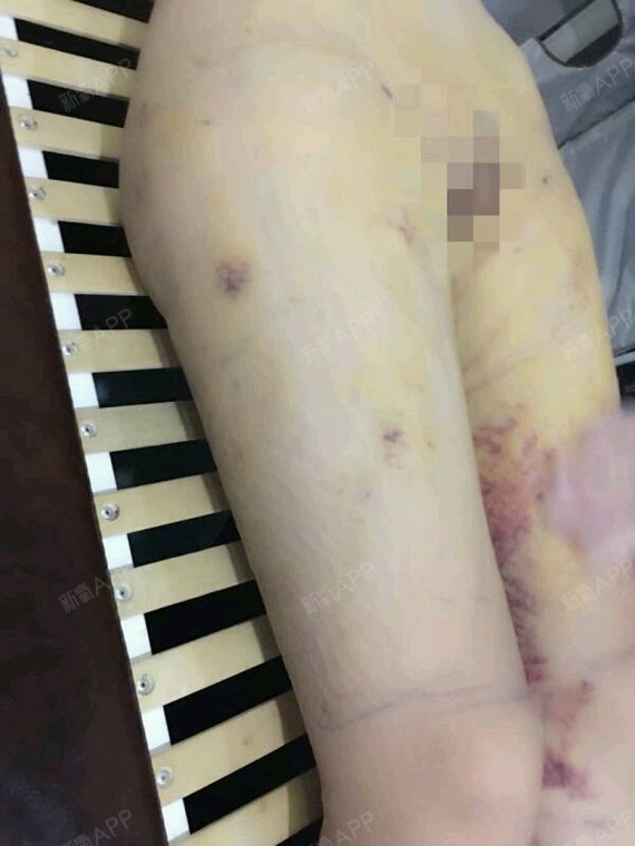 人生的路一起走吧吸脂瘦大腿第7天美丽日记