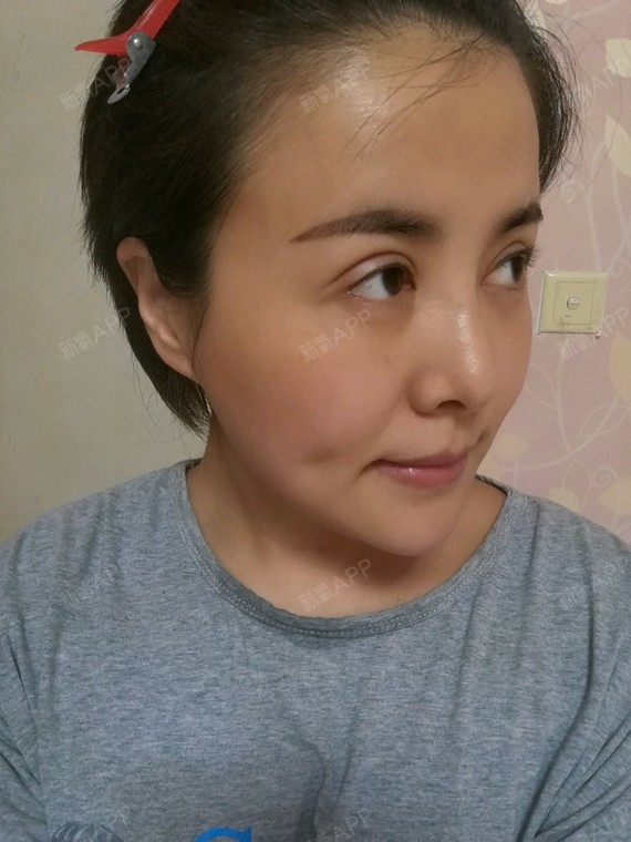 萌逗逗PRP腿部自体美肤第3天美丽日记-新氧美血清肌肉瘦腿图片