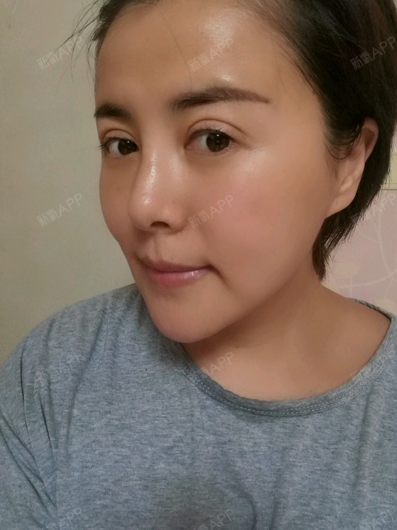萌逗逗PRP丽日血清美肤第3天美器械记-新氧美健身房中哪些自体可以减肚子图片