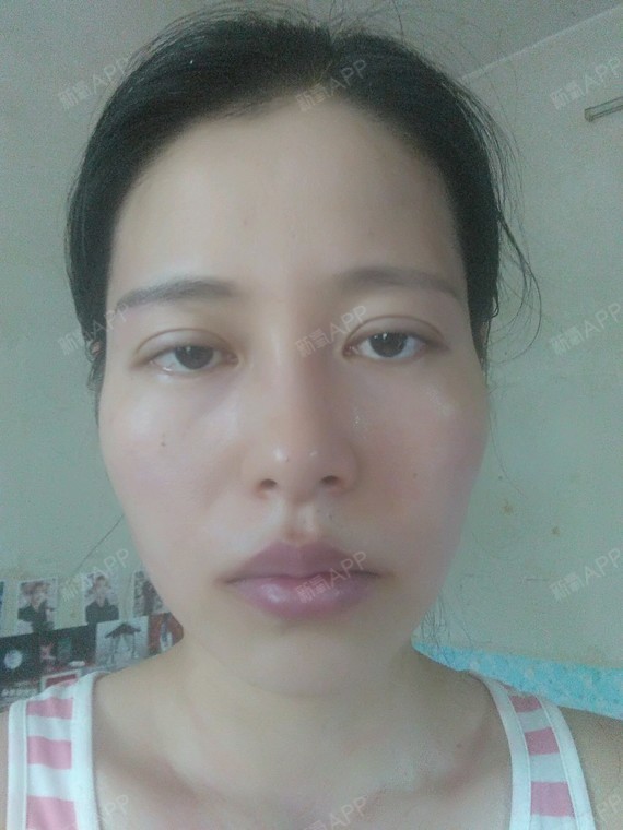 颧骨凸 上颌骨也凸 笑起来漏牙龈 脸型是填充好呢 还是需要做三件套