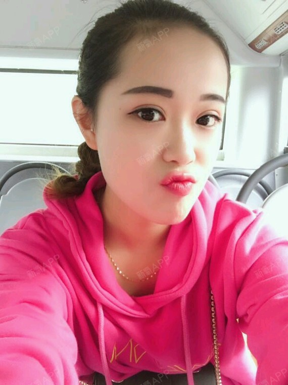 ――深圳联合丽格医疗美容――这是我做过的双
