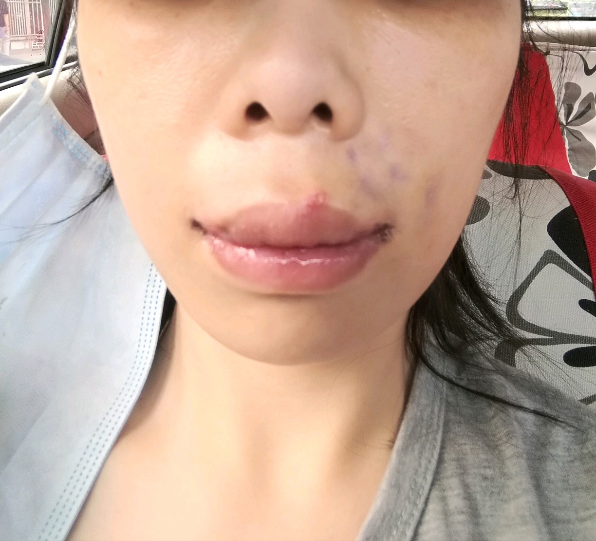 m唇手术第21天