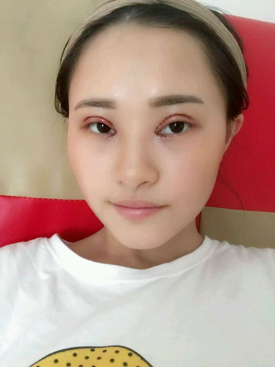 告别我的单眼皮,告别我的鱼泡眼