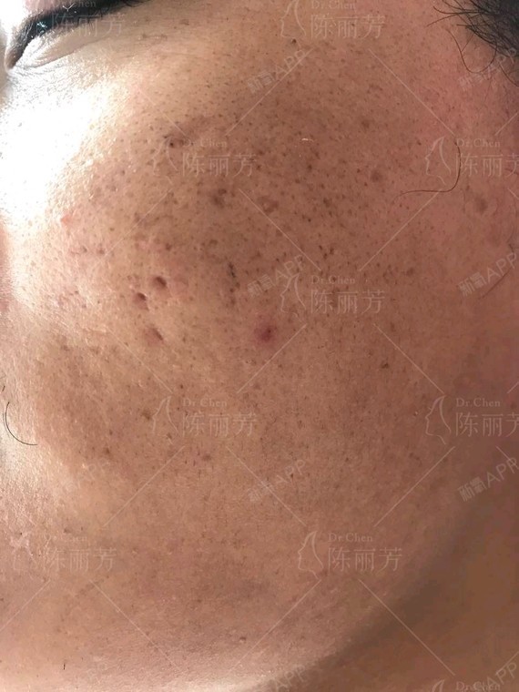 痘坑是一种由于感染发炎或外力挤压所致的脸部