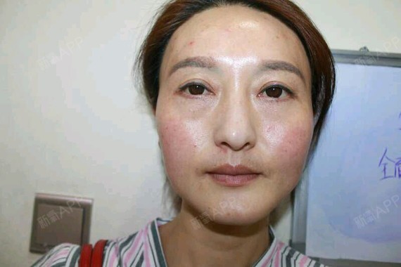 面部吸脂后松弛怎么办