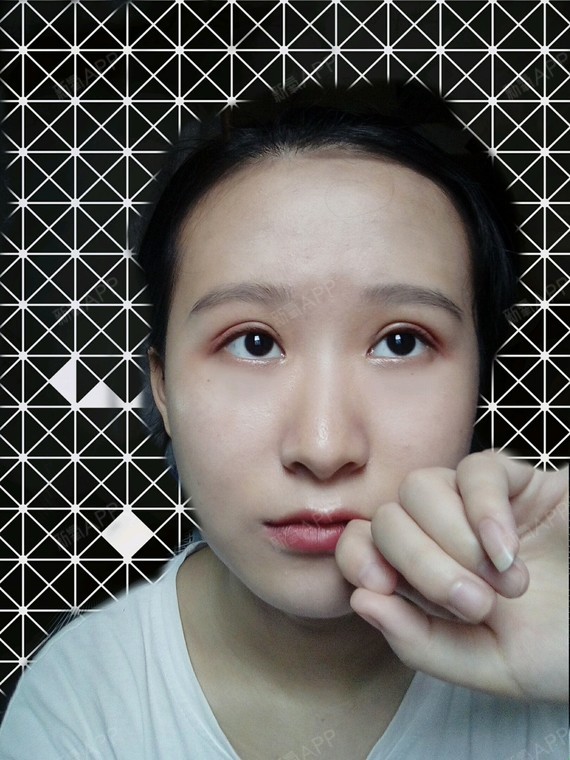 切开双眼皮