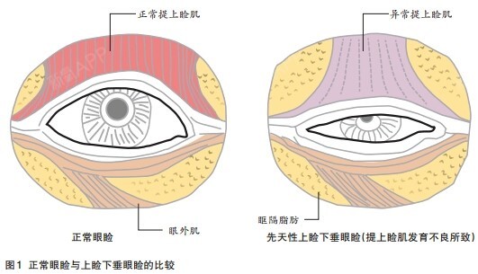 【深圳晨曦整形】由于上睑提肌功能缺陷,造成上眼睑皮