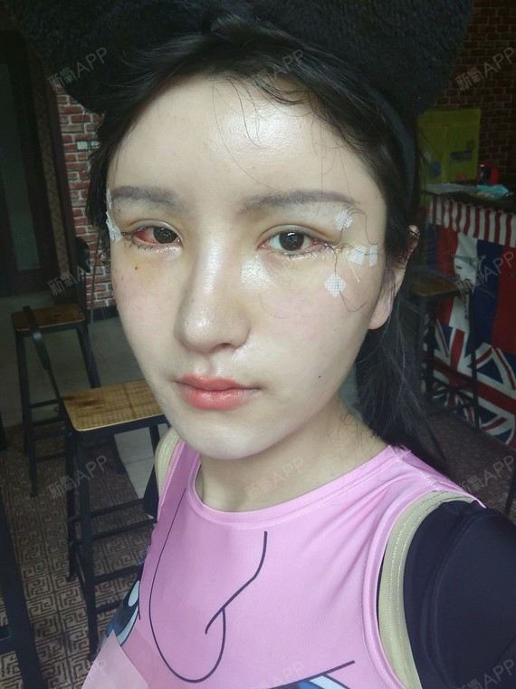 成都开外眼角好不好_效果图_dudu居开外眼角术后第天