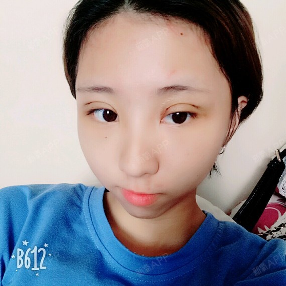 韩式三点双眼皮
