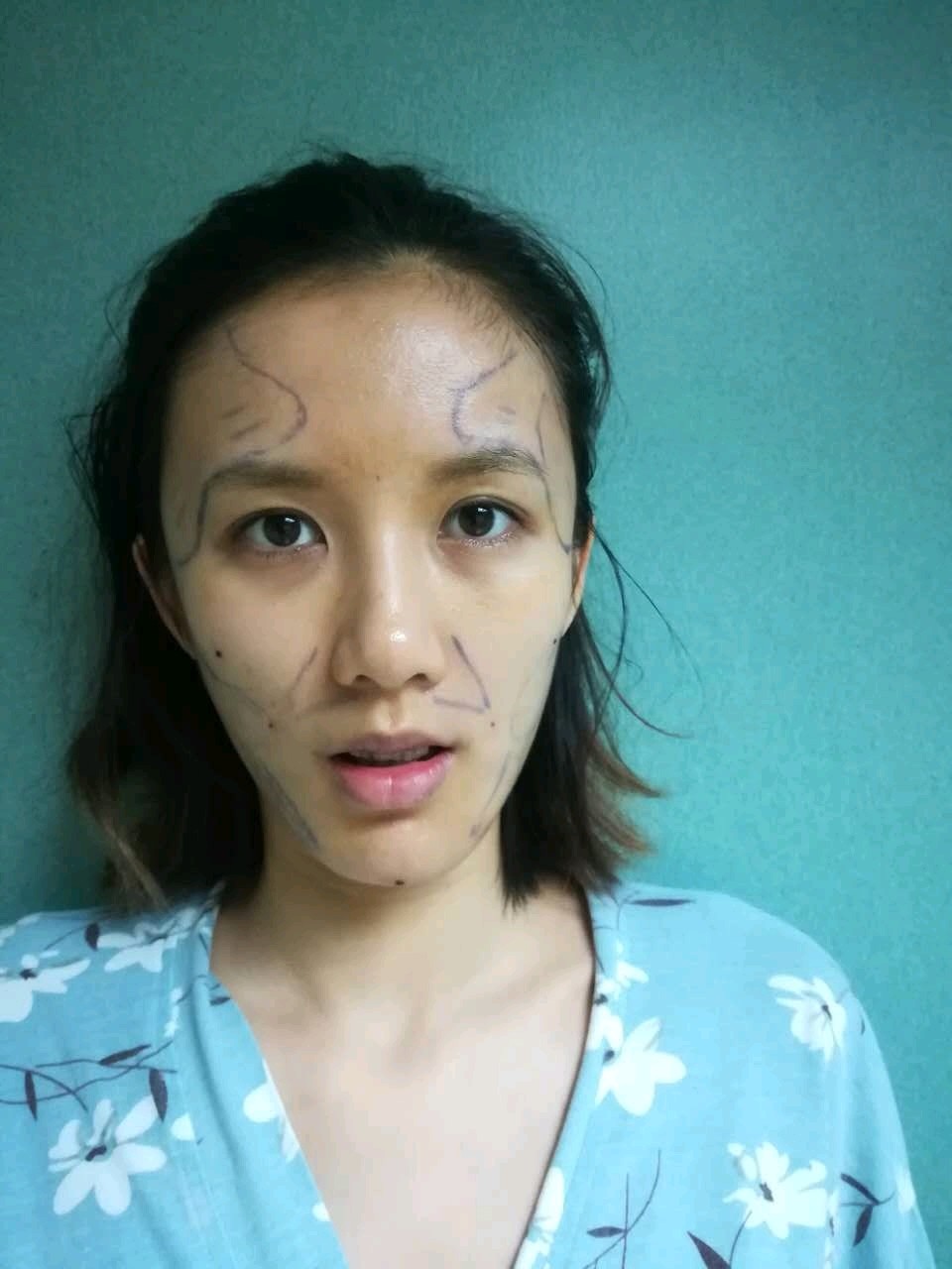 严重肿胀期自体脂肪全脸填充第 天