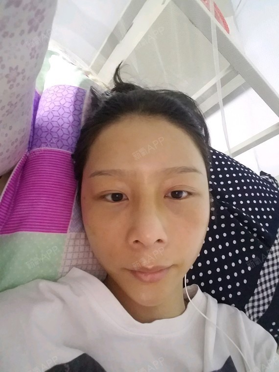 宝贝baber自体脂肪填充全脸第14天美丽日记-新