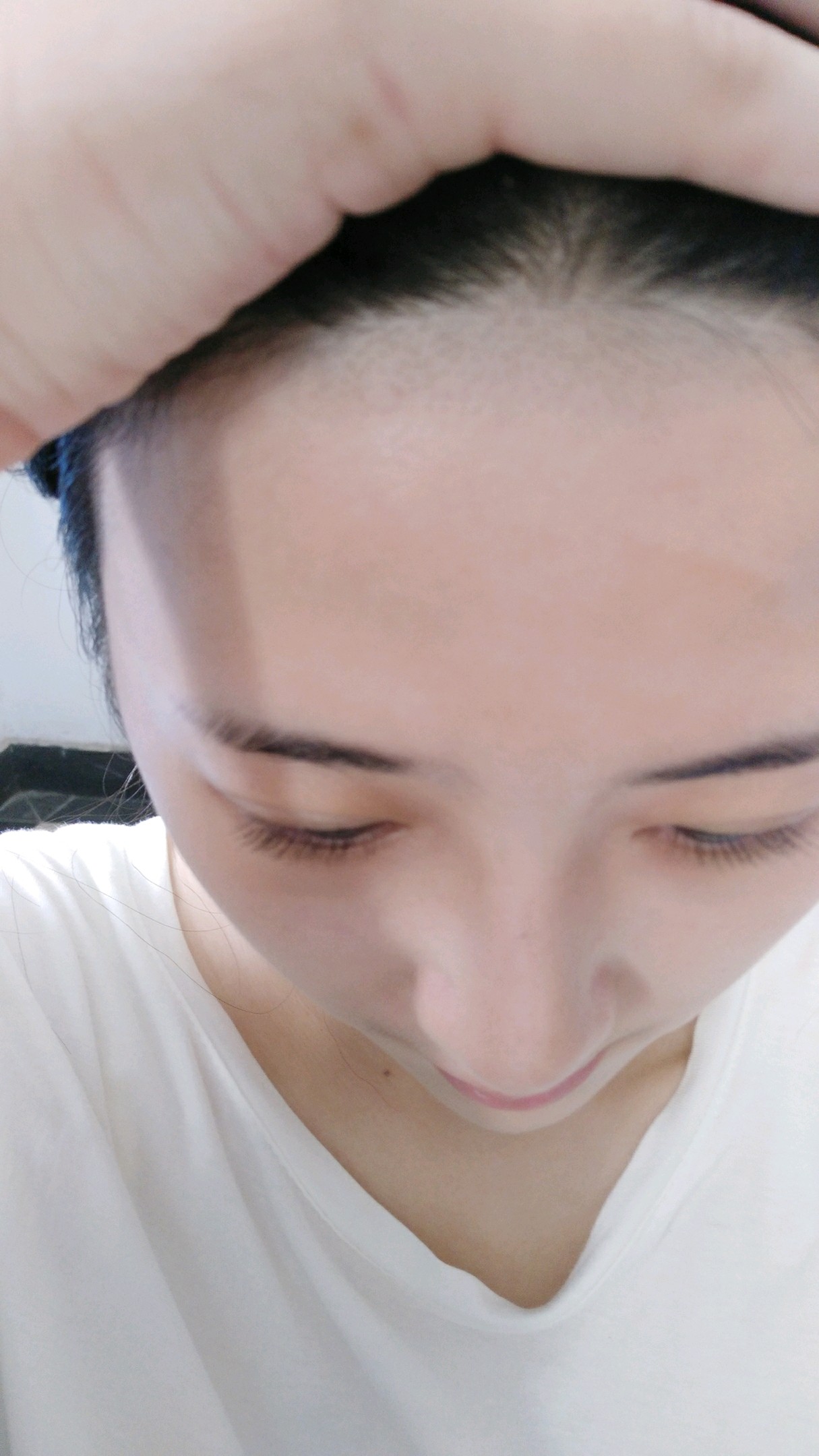 脱发际线第2天