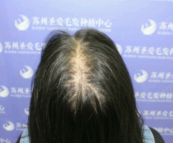 苏州李小姐发顶头发加密德国polo无痕加密技术