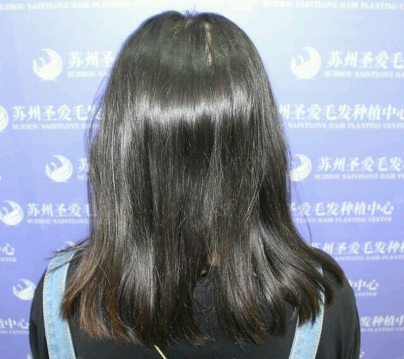 苏州李小姐发顶头发加密德国polo无痕加密技术