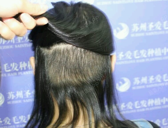 苏州李小姐发顶头发加密德国polo无痕加密技术