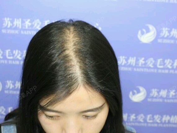 苏州李小姐发顶头发加密德国polo无痕加密技术