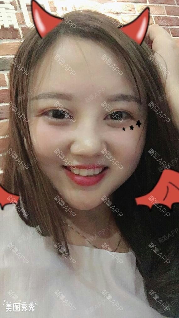 激光美白祛斑前要注意什么?激光祛斑效果最明