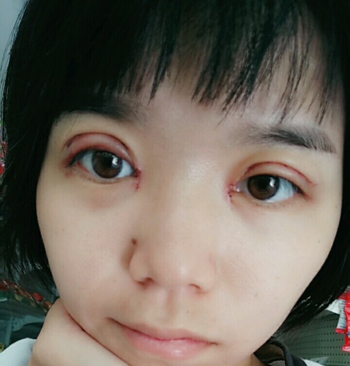开内眼角怎么样_恢复过程_效果如何_胖仔妈咪整形日记9.