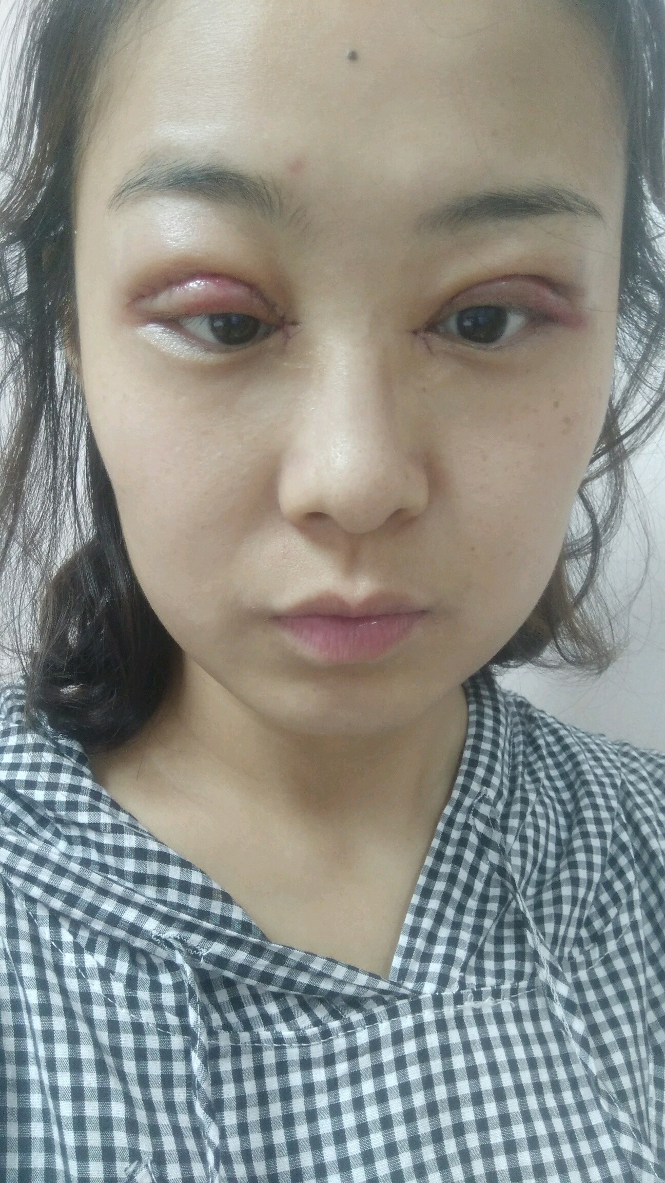 开内眼角怎么样_恢复过程_效果如何_氧气1lr409b整形9