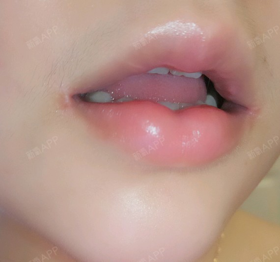 这张照片可以看到嘴巴里面的疤痕增生,而且还有一个地方凸出来了一颗!