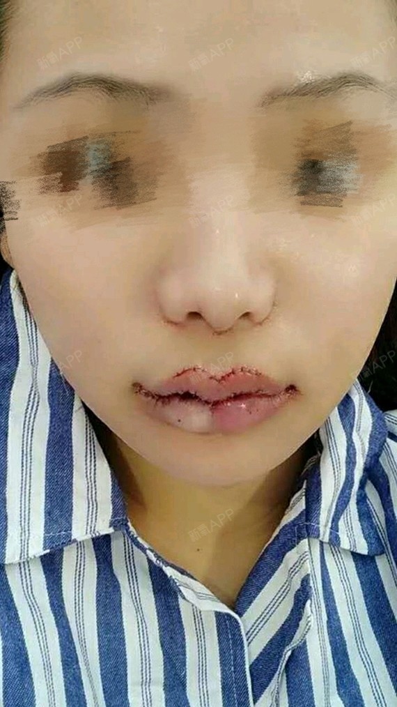 m唇手术好不好_效果图_感谢你走过黑暗来到我身边m唇1