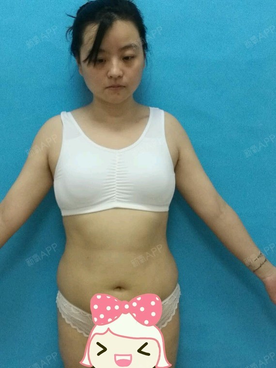 新氧-cici安妮|美体美体|腹部瘦吸脂|腰部瘦吸脂|塑形减肥苦菊减肥吃怎样能图片