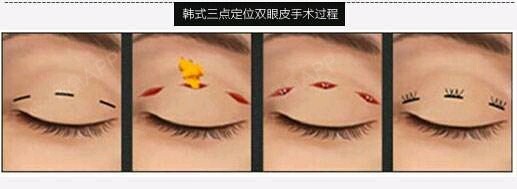 割双眼皮术后多久不能沾水呢?割双眼皮手术本