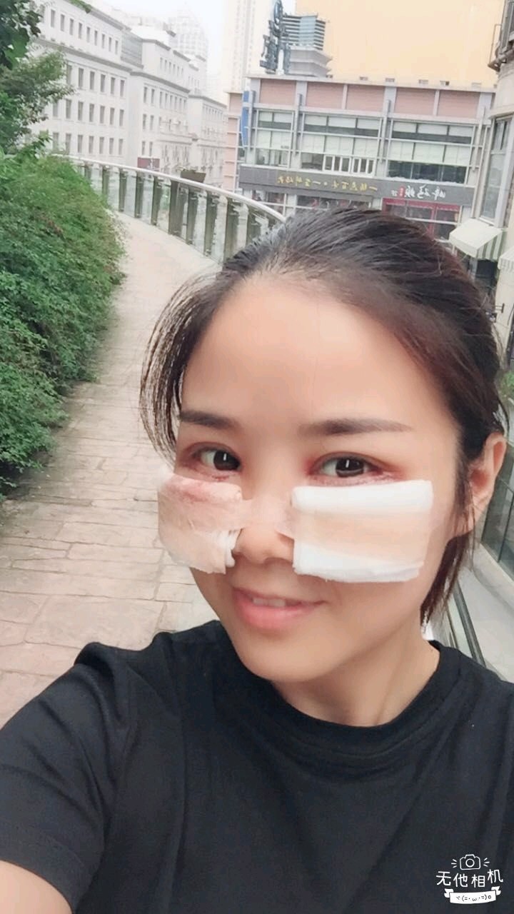 外切去眼袋第0天