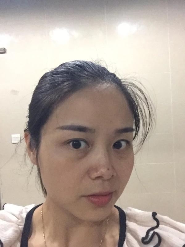 外切去眼袋怎么样_恢复过程_效果如何_沫筱熙整形日记
