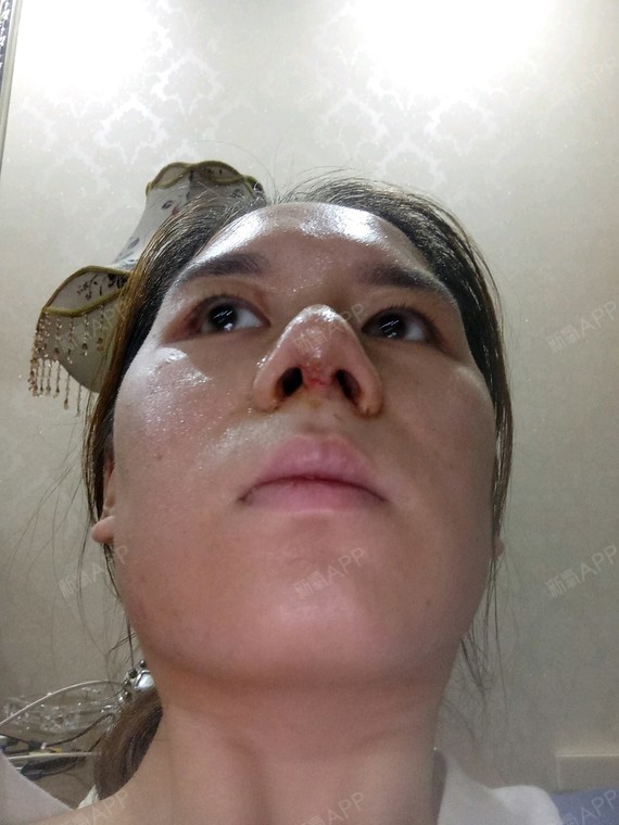 歌颂者lan手术缩鼻头第3天美丽日记-新氧美容