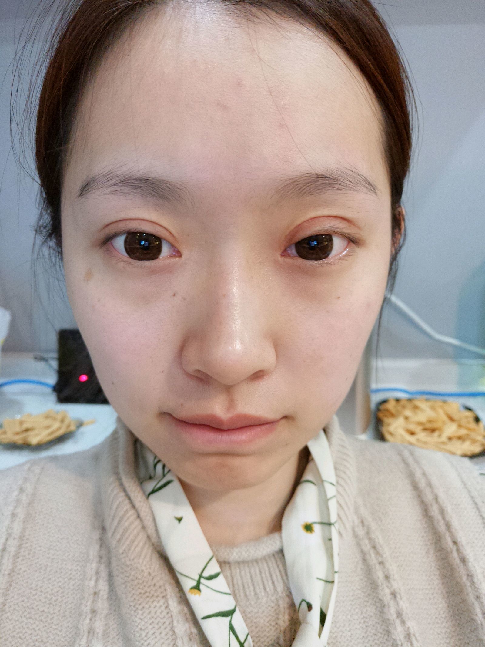 切开双眼皮第30天