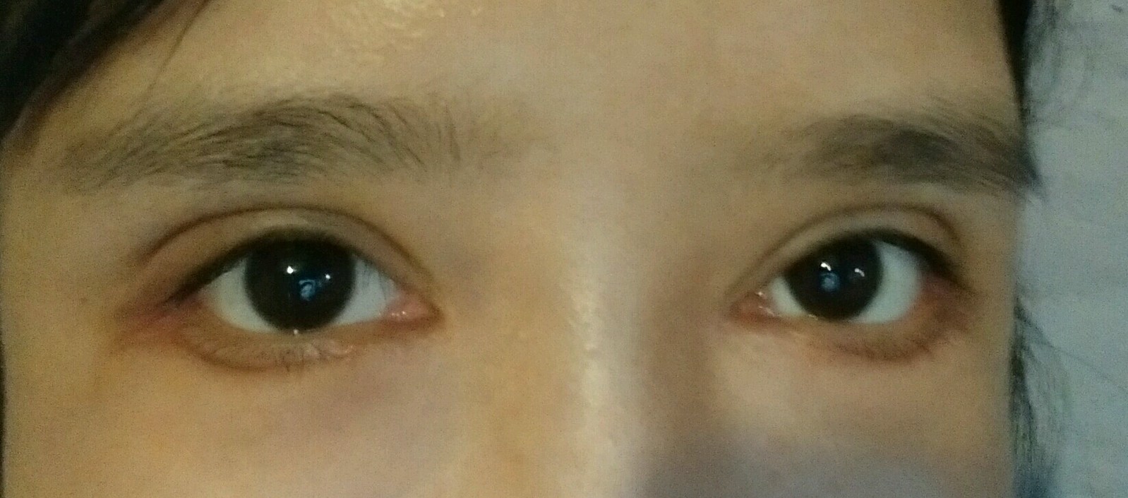 我也是做了外切可是都二十天了  眼袋还在笑起来下面和双眼皮一样
