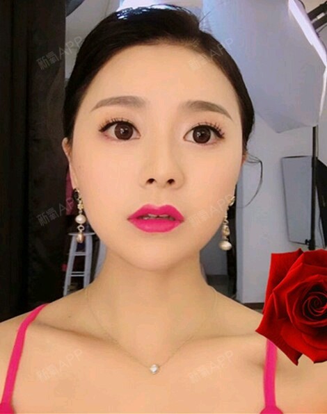 小九九妹玻尿酸丰面颊第18天美丽日记视频拉机弯图片
