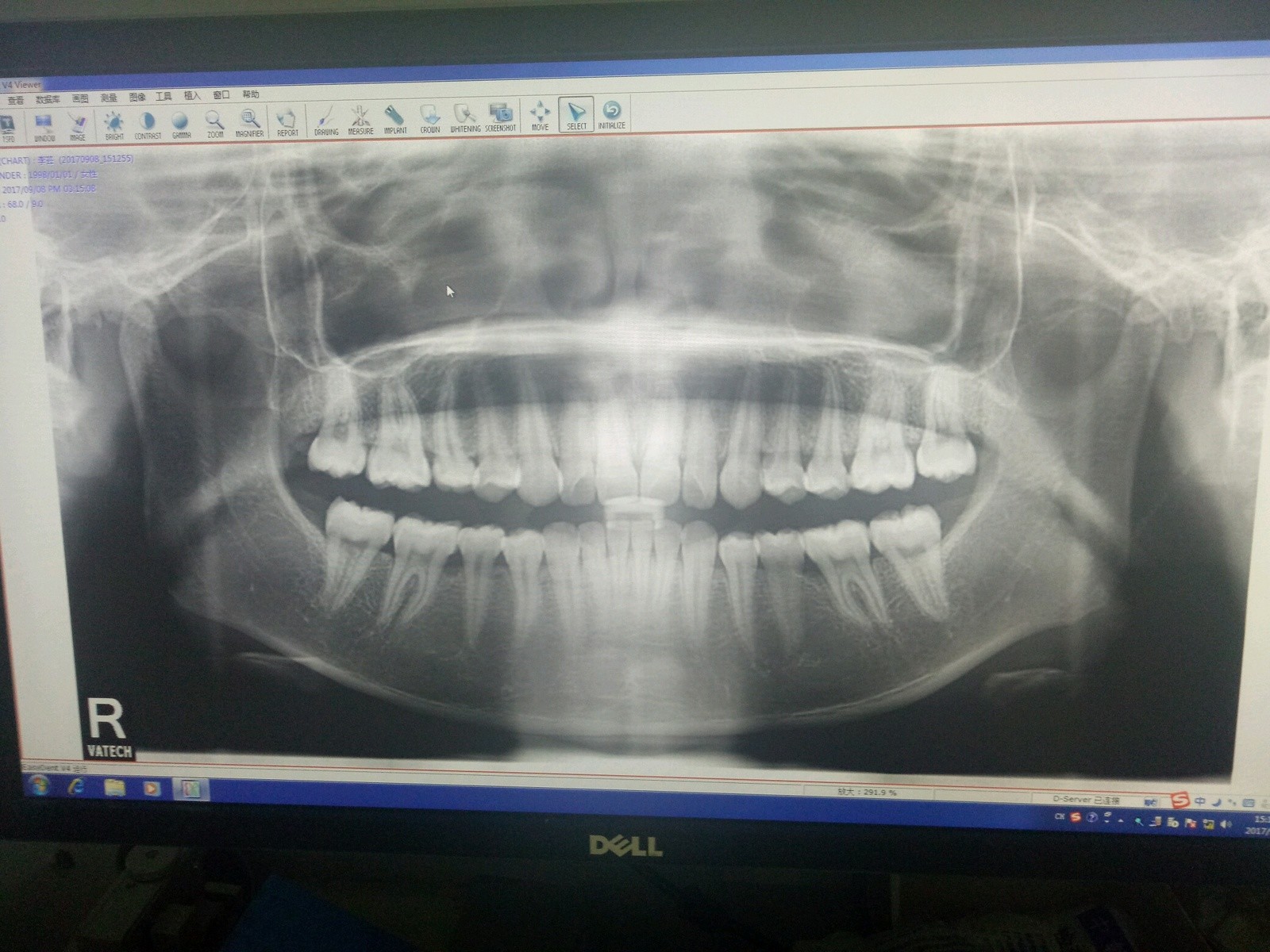 再来几张牙片的,和正面牙齿的情况给大家看下