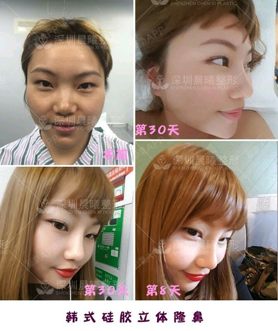 【深圳晨曦整形】假体植入改善因鼻梁塌陷而导致中面部凹陷让五官缺乏