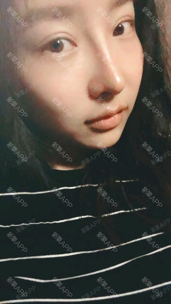 新氧-丽无极限|脸部脂肪|PRP面部局部移ps轮廓瘦身图片