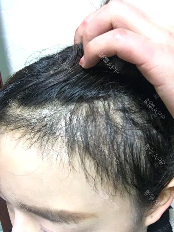 [种植发际线两个月后]恢复很好哟,头发都已经长