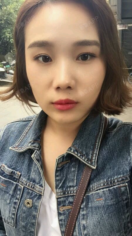 目前有哪几种双眼皮手术方式?一、埋线法手术