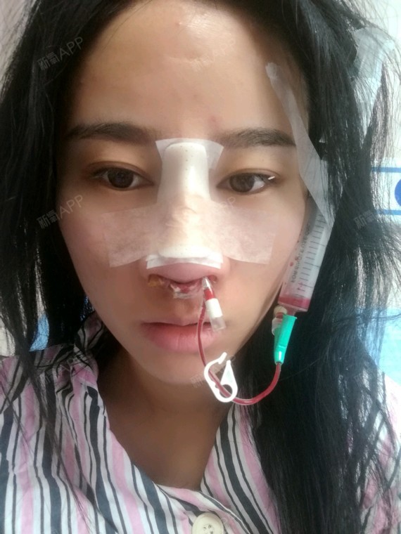 鼻头整形 | 自体软骨隆鼻 | 宽鼻矫正 | 术后当自强 | 鼻骨矫正