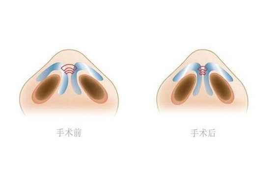 蒜头鼻的评判标准，鼻头缩小手术过程