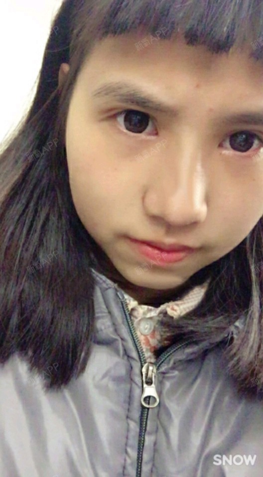 隆鼻假体取出注意事项