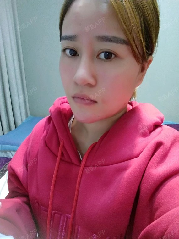 kmt335400玻尿酸垫下巴第0天美丽日记-新氧美