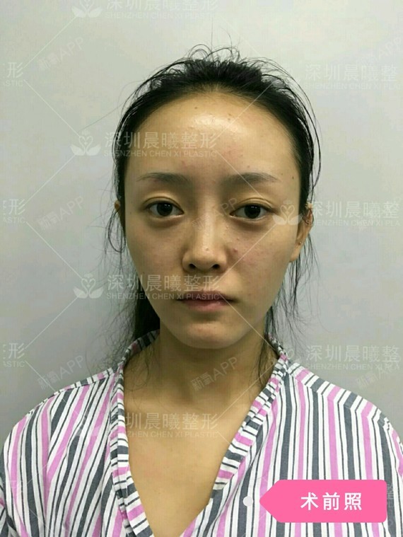 【深圳晨曦整形】自体脂肪填充全脸,吸脂瘦身