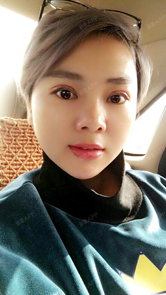 氧气9370491511315878上眼睑去脂第1天美丽