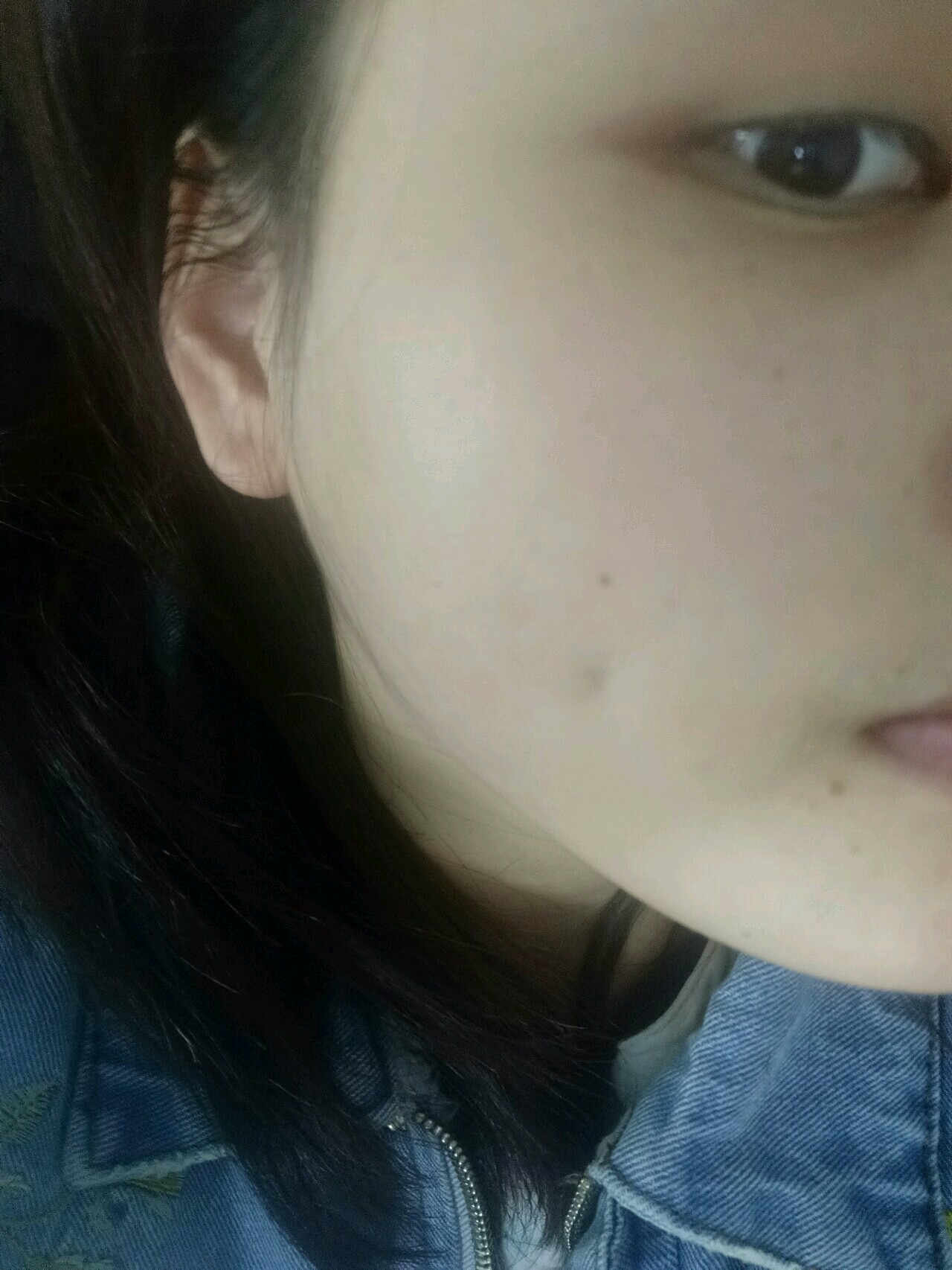 酒窝成形术怎么样?_不爱吃香菜美丽日记-新氧美容整形
