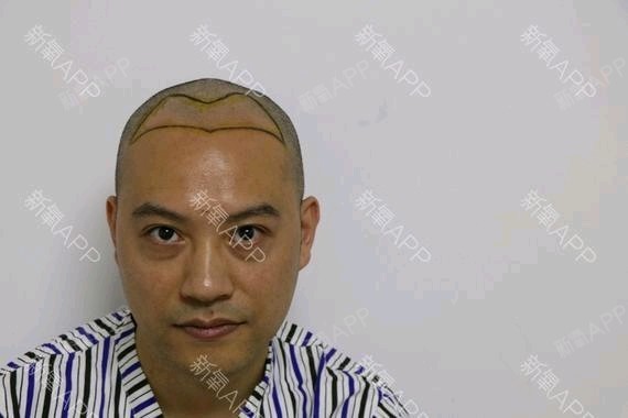 [种植发际线手术术后0效果]头发是人的第二修