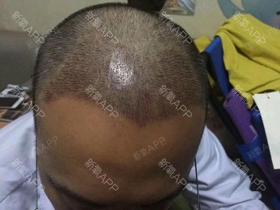 [种植发际线手术术后0效果]头发是人的第二修