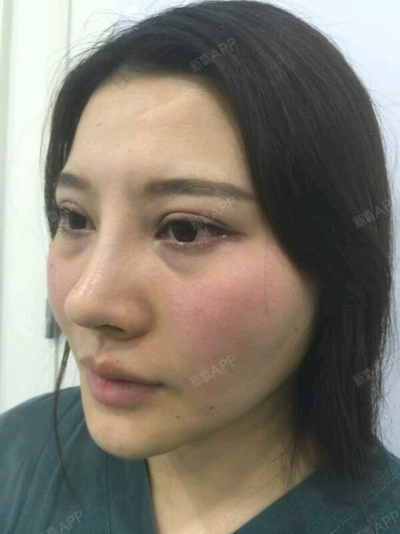 莎莎拉埋线提升第0天美丽日记-新氧美容整形