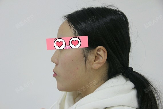 【武汉康美莱-鼻综合第零天】总觉得自己鼻子